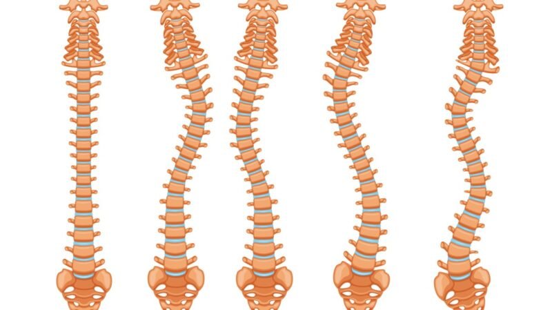 scoliosis_pic